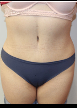 After Image: Tummy Tuck - front