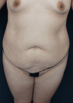 Before Image: Tummy Tuck - front