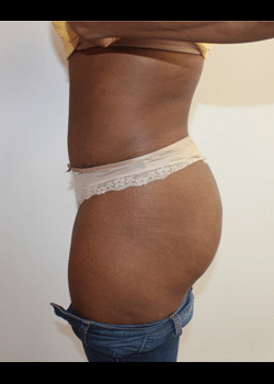 After Image: Tummy Tuck - left-side