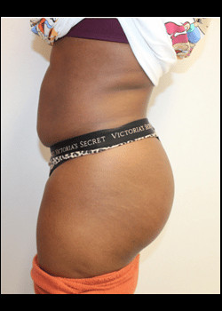 Before Image: Tummy Tuck - left-side