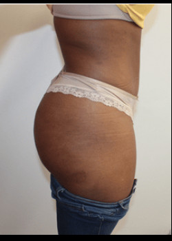 After Image: Tummy Tuck - right-side