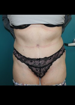 After Image: Tummy Tuck - front