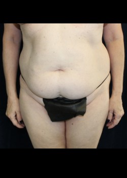 Before Image: Tummy Tuck - front