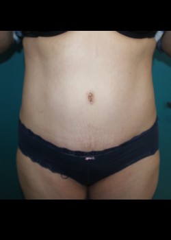 After Image: Tummy Tuck - front