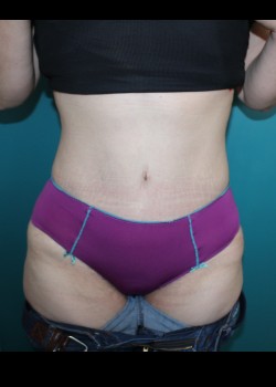 After Image: Tummy Tuck - front